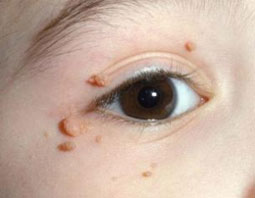 Hình ảnh bệnh nhân bị Hạt cơm ở mặt (mụn cơm, mụn cóc) do nhiễm Virút HPV