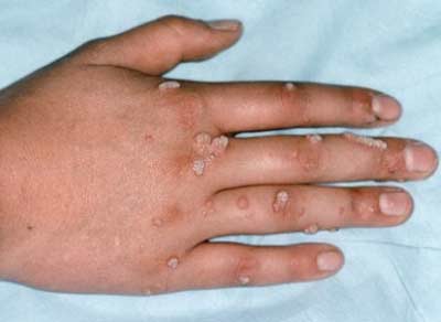 Hình ảnh bệnh nhân bị Hạt cơm ở tay (mắt cá, mụn cơm) do nhiễm Virút HPV